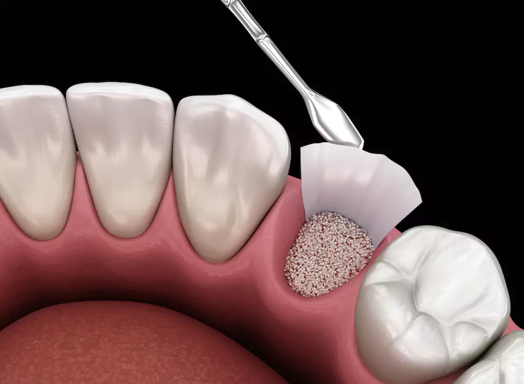 Dental Bone Grafts: Restoring Strong Gum Foundations